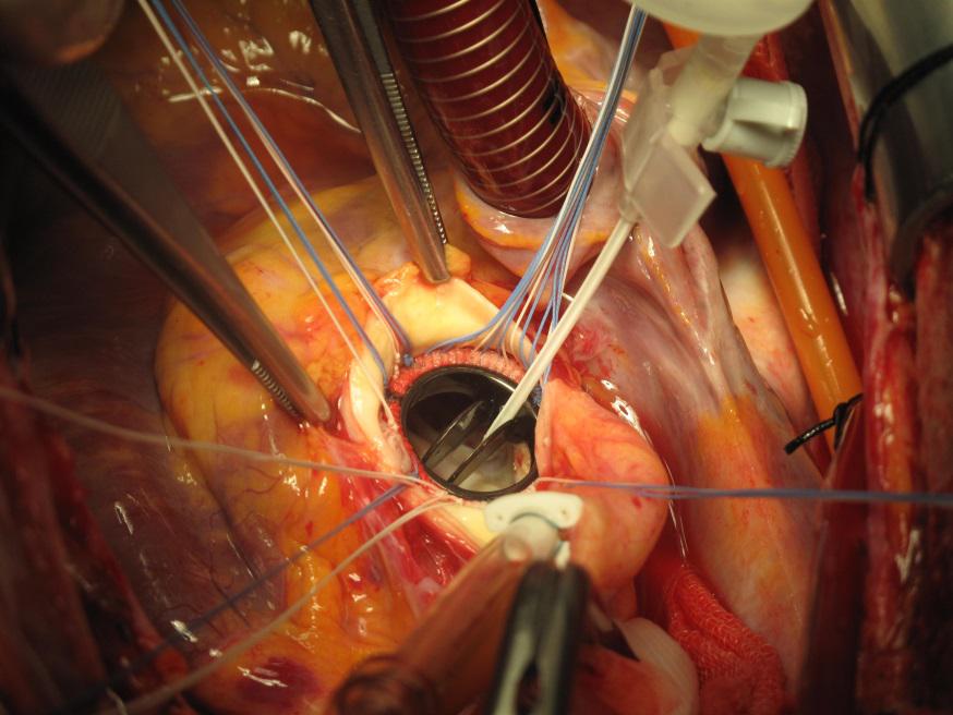Operasyonla aort kapak takılması