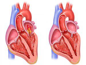 kalp-hastaliklari-3