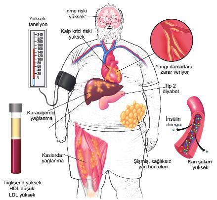Metabolik Sendrom Nedir? Belirtileri ve Tedavisi