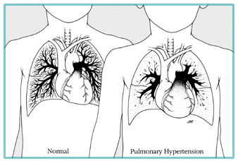hipertansif akciğerler