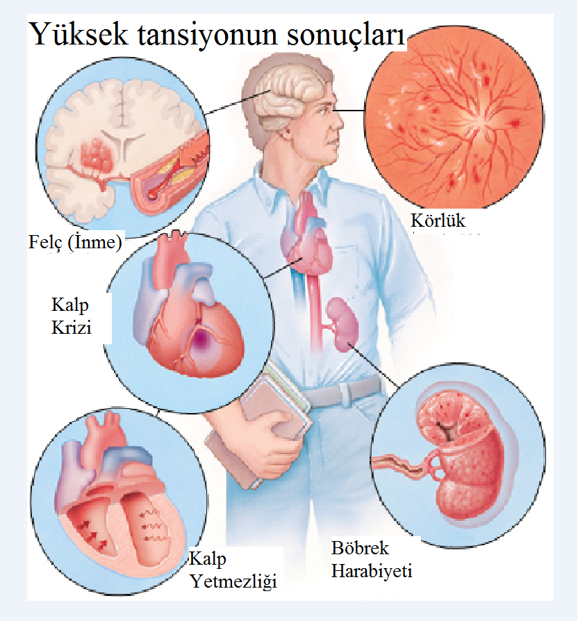 Renal arter stenozu: Türkiye'de semptomlar ve tedavi